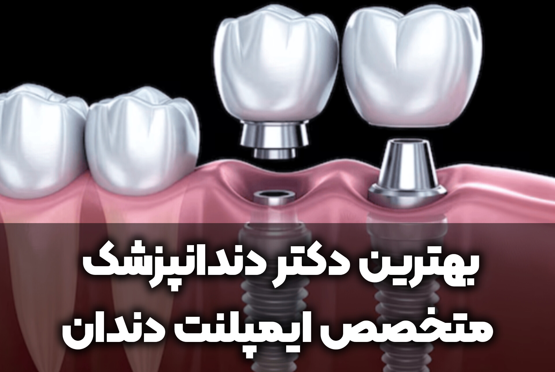 دنتارو بهترین دکتر دندانپزشک متخصص ایمپلنت دندان