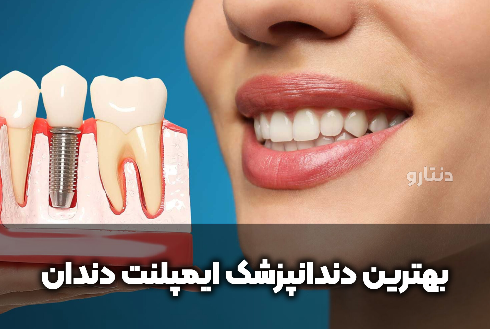 دنتارو بهترین دندانپزشک ایمپلنت دندان