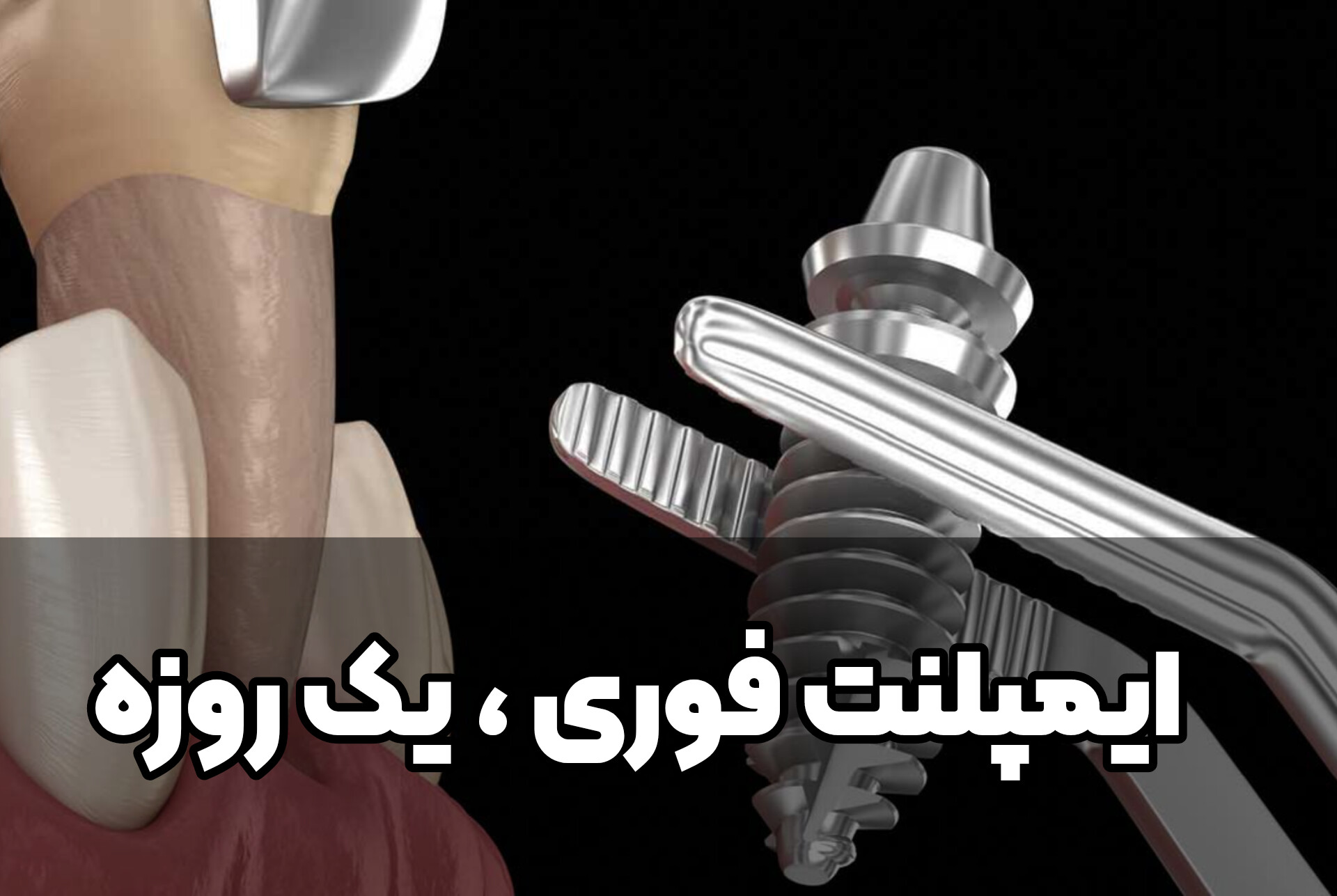 دنتارو ایمپلنت فوری | ایمپلنت یک روزه